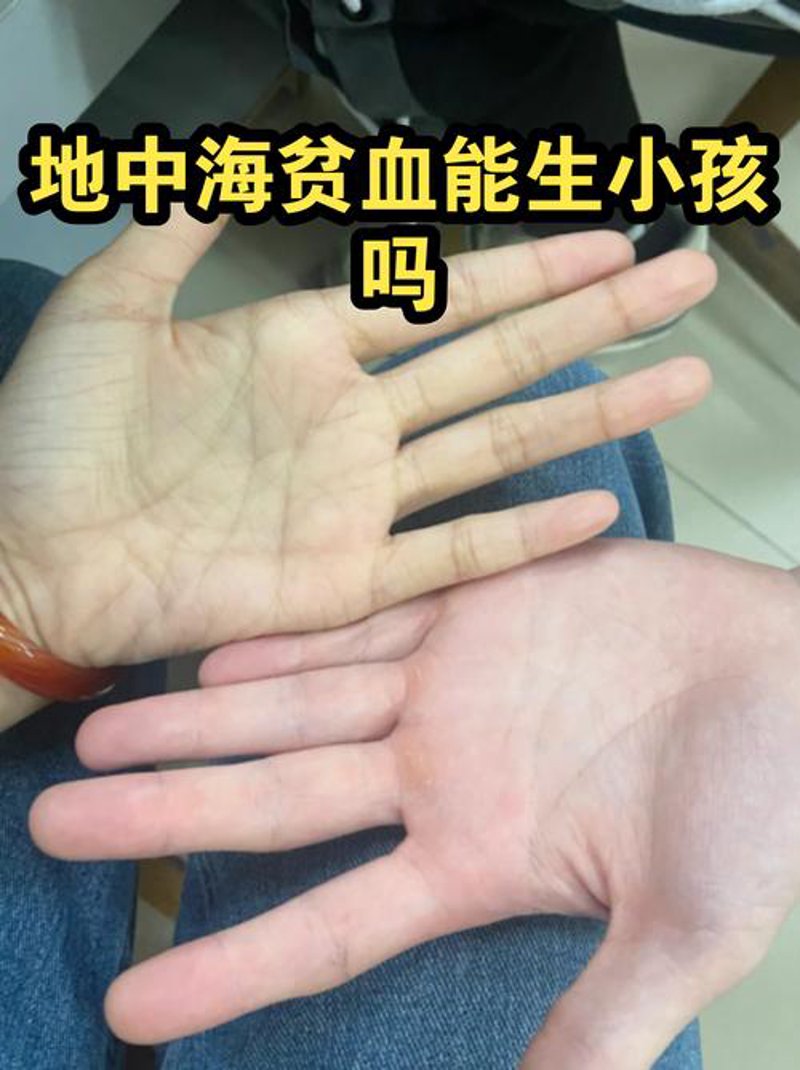 血红蛋白病：揭开血液疾病的神秘面纱